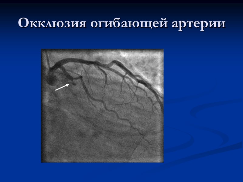 Окклюзия огибающей артерии
